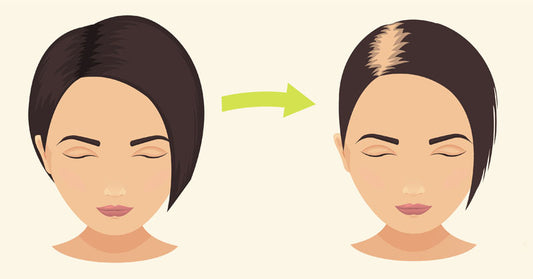 Is Hair Loss At 18 Normal