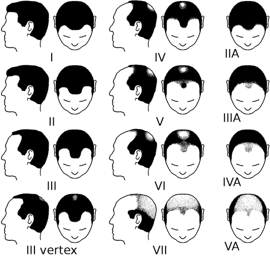Hair Thinning At Crown for Male